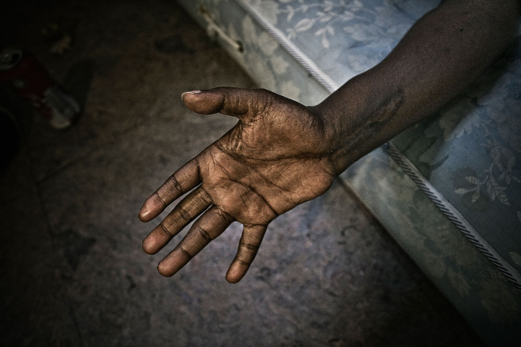 ITALY. Florence, 20th June 2011. The hand of a Somali refugee. He had an accident when he was working like a forklift truck operator. After surgery he remained not able to tighten his hand and consequently not able to work. Nowadays he received a life annuity from the Italian state.